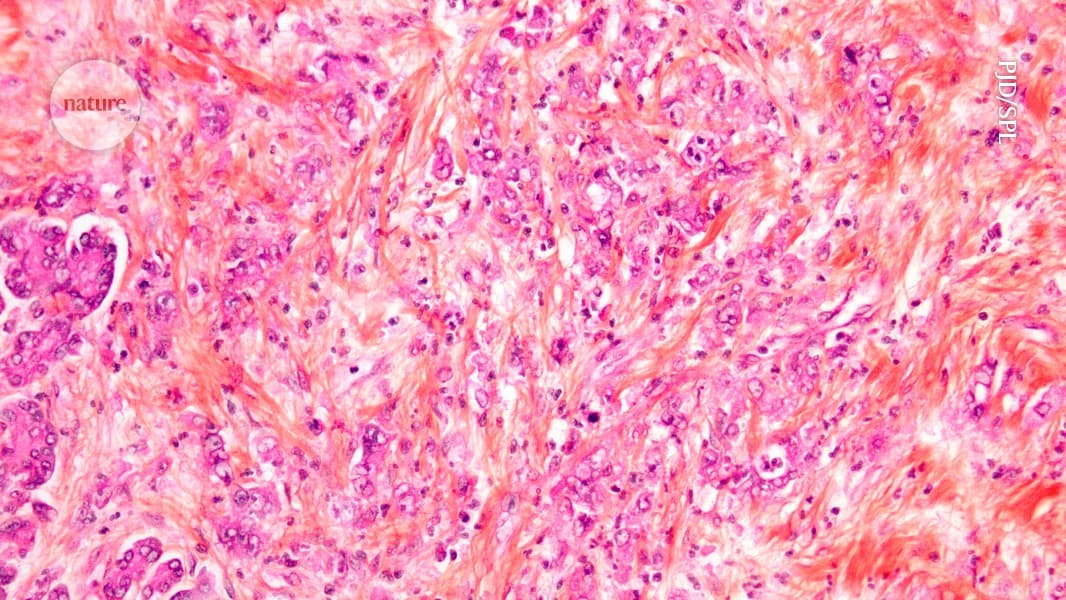 Cáncer KRAS: Protocolo Integral para la Prevención, Monitoreo y Avance