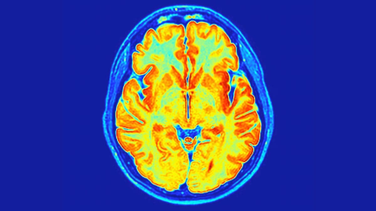 Neurodesarrollo: Descubren un trastorno genético con profundas implica